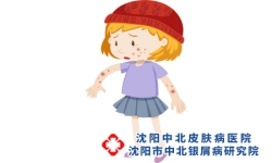 女性为什么容易患上牛皮癣呢？
