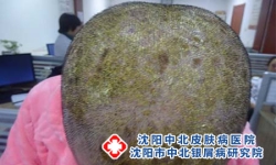 换季总怕银屑病找上门?日常做好这几件事更安心