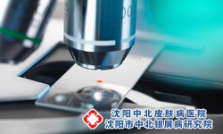 牛皮癣累及脏器需查血常规