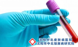 银屑病前期需要做那些检查