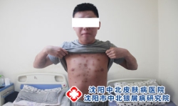 身上红斑就一定是银屑病吗？