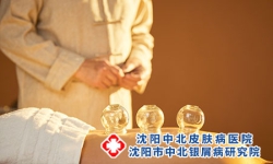 沈阳牛皮癣病人能拔火罐吗