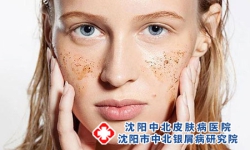 点状牛皮癣有哪些特殊表现形式?
