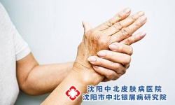 钱币型牛皮癣的概念-钱币型牛皮癣是什么