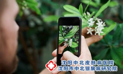 沈阳中北银屑病医院有没有治疗银屑病的
