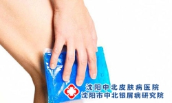 牛皮癣的关节炎要怎么办?