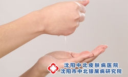 红皮型牛皮癣为啥会水肿？
