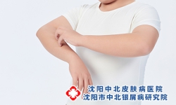 牛皮癣瘙痒能不能挠皮肤