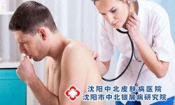护理牛皮癣患者的四大方法