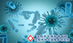 牛皮癣的保守治疗方法是什么