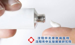 牛皮癣发痒该用哪种药物呢?