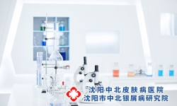 牛皮癣的治疗与预防
