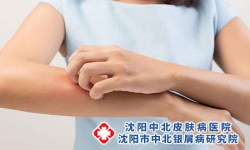 湿热型银屑病的治疗难度与策略