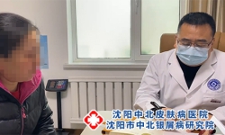 沈阳治银屑病医院排名?皮肤镜检查银屑病准吗?