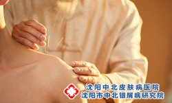 一般中医治疗牛皮癣有啥常见的方法？