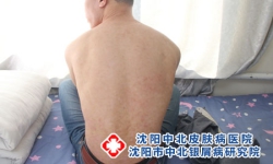 银屑病饮食如何好呢?