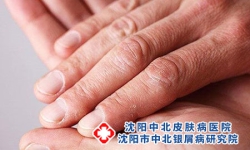 易与牛皮癣混淆的5种疾病是什么