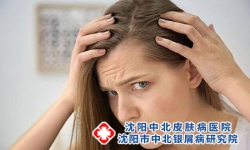 头上长牛皮癣传染吗 牛皮癣如何预防