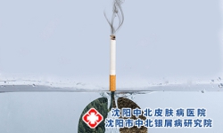 警惕吸烟会加重牛皮癣的病情 牛皮癣生活护理