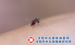 沈阳牛皮癣病患怎样防蚊虫叮咬
