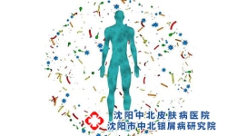 牛皮癣究竟是什么原因引起的 牛皮癣的注意事项有哪些呢