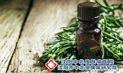 患有多年的顽固牛皮癣有什么偏方？