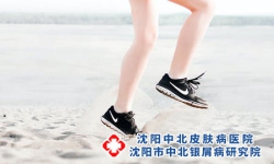 牛皮癣是白癜风吗-牛皮癣和白癜风区别细说