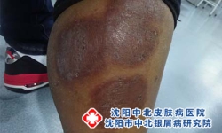 银屑病是湿气重导致的吗？中医视角解析病因