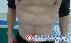 银屑病跟脂溢性皮炎 头上长红斑掉屑分不清太容易搞错
