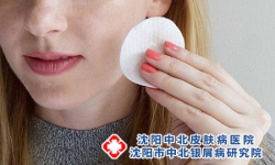银屑病应注意哪些生活习惯