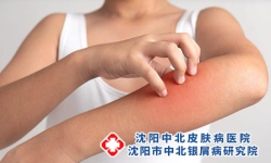 牛皮癣最快止痒方法 牛皮癣的注意事项