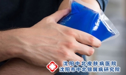 牛皮癣分哪几种类型呢