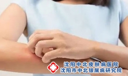 有哪些常见的诱因会导致牛皮癣的发作?