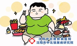 牛皮癣用药后要忌口吗?