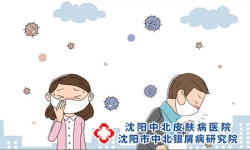 牛皮癣的治疗原则 牛皮癣怎么治疗