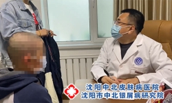 沈阳看银屑病医院沈阳专业银屑病医院,关节型银屑病有哪些症状?