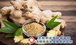 牛皮癣患者可以吃姜吗?沈阳沈北新区治疗牛皮癣专科医院哪里好