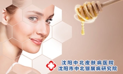 沈阳牛皮癣医院：面部有牛皮癣怎么洗脸？