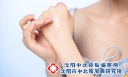 牛皮癣患者夏季应该如何护肤 牛皮癣的注意事项