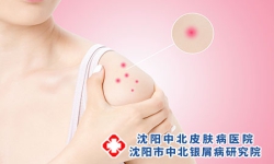 红皮型银屑病有什么症状?