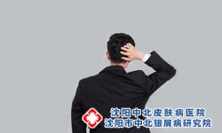 怎么鉴别副银屑病？