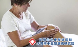 牛皮癣关节炎是指什么 牛皮癣关节炎治疗