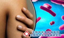 牛皮癣和病毒性的感染有关吗?