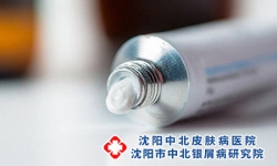 外用药可以治好沈阳牛皮癣吗