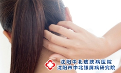 是什么会影响到牛皮癣加重病发