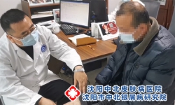 银屑病用什么药膏好：专业解析与沈阳中北皮肤病医院的治疗建议