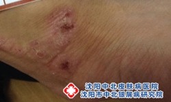 皮炎患者必看：这些水果千万不能碰