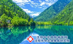 夏季银屑病，避免五个关键点