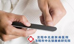 银屑病甲怎么恢复正常？