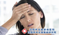 牛皮癣白斑多久能好 牛皮癣怎么治愈